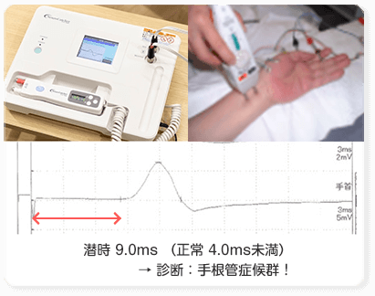 神経伝導速度検査